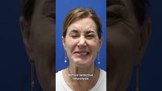 HUGE transformation after selective neurolysis surgery plasticsurgery facialparalysis facialpalsy [upl. by Limemann]