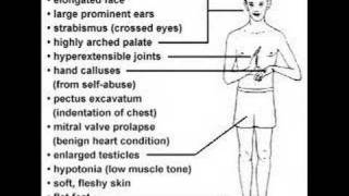 Fragile X Syndrome [upl. by Notnarb]