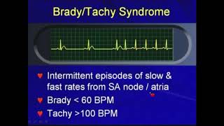 51c BradyTachy Syndrome  Bradyarrhythmias Hong Kong University [upl. by Atalie365]