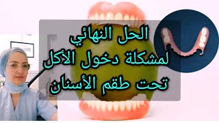 الحل النهائي لمشكلة دخول الأكل تحت طقم الأسنان المتحرك الكامل و الجزئي Prothèse dentaire amovible [upl. by Knoll701]