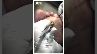 Planter Wart Removal legwart viral [upl. by Olinad]