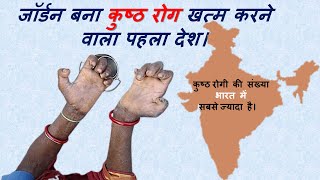 Leprosy  Hansens Disease  कुष्ठ रोग Jordan  India  WHO [upl. by Macnamara]