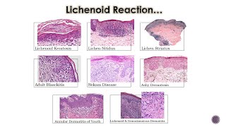 8 Lichenoid Dermatoses 2 [upl. by Birch]