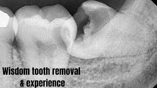 wisdom tooth removal surgery amp experience recovery l Malayalam wisdomteeth wisdomteethremoval [upl. by Best]