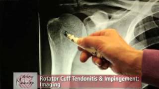 Rotator Cuff Impingement amp Tendonitis Part 2 Symptoms amp Evaluation [upl. by Gemoets]