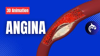 Angina 3D Animation  Understand Chest Pain from Reduced Blood Flow to the Heart [upl. by Stanwin831]