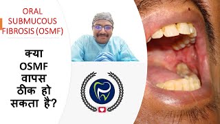 Dr Rudra Mohan  is OSMF reversible  क्या OSMF वापस ठीक हो सकता है Oral Submucous Fibrosis [upl. by Woothen]