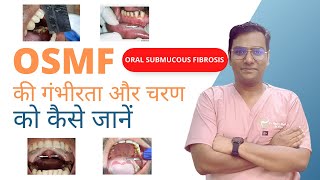 Dr Rudra Mohan  Oral Submucous Fibrosis OSMF STAGING ओएसएमएफ की गंभीरता और चरण को कैसे जानें [upl. by Odarnoc]