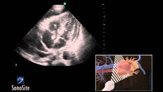 How To Ultrasound Guided Pericardiocentesis Procedure 3D Video [upl. by Arrahs581]