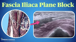 Fascia Iliaca Plane Block [upl. by Cary]