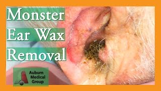 Monster Ear Wax Removal Brings New Life to JOKESTER Patient  Auburn Medical Group [upl. by Aisyle186]