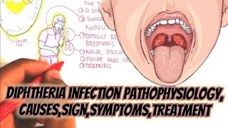 Diphtheria Infection Pathophysiology CausesSignSymptomsTreatment [upl. by Harat723]