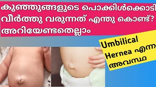 Umbilical Hernea in newborn Babies Malayalam Umbilical Hernea in infants Umbilical Hernea [upl. by Ahseram]