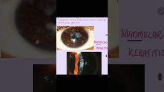 Nummular keratitis cornea keratitis eyes ophthalmology [upl. by Kacie]