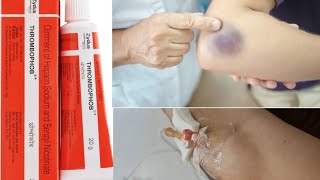 Thrombophob ointment  Treatment ofThrombosis  Superficial Blood Clotting  medicine information [upl. by Pat]