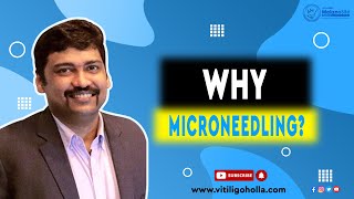 Microneedling Treatment for vitiligo explained by Dr A P Holla  Melanosite [upl. by Verlie]