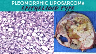 Pleomorphic liposarcoma epithelioid type Oregon Case 15 pathology sarcoma spindle cell neoplasm [upl. by Llertnad]