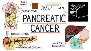 Understanding Pancreatic Cancer [upl. by Zile]