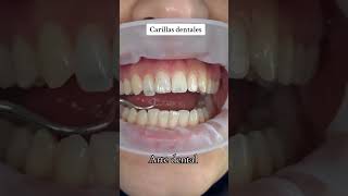 Carillas dentales carillasdentales esteticadental parati sonrisaperfecta carillas fypシ゚viral [upl. by Nrubua]