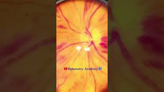 Flame shaped Hemorrhages  proliferative diabetic retinopathy PDR  Short Video 180 [upl. by Lehcor]