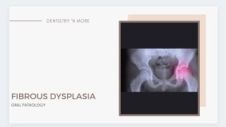 FIBROUS DYSPLASIA [upl. by Yusuk]