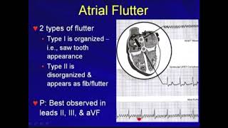 43a Atrial Flutter  Tachyarrhythmias Hong Kong University [upl. by Odragde888]