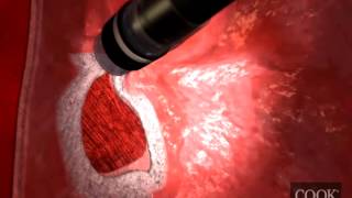 Duette™ MultiBand Mucosectomy Animation [upl. by Roque]