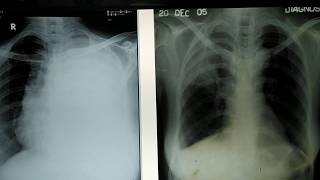 X Ray Chest  Pleural Effusion Vs Pulmonary Fibrosis  How to differentiate  MBBS final [upl. by Sillihp981]