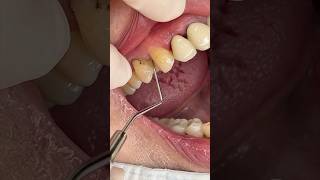 치주낭 ￼ 잇몸질환 gingival probing pocket depth 치주탐침 dental periodontitis [upl. by Uriiah]