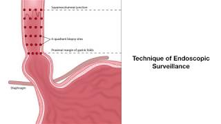 Barretts esophagus biopsiesGraphic Illustration [upl. by Botzow]