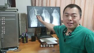 hallux valgus 再说一下痛风和拇外翻的诊断及痛风合并拇外翻是否可以手术？ [upl. by Dnalyar]