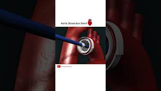 Aortic dissection Stent grafting cardiology shorts [upl. by Lithea468]