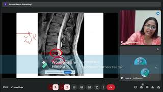 Prolapsed Intervertebral Disc Anatomy of IV Disc Part 2 [upl. by Patton]