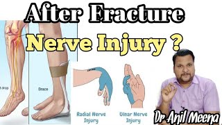 Nerve Injury treatment after fracture  complications after Nerve Injury  nerve injury in hindi [upl. by Nimajnab]