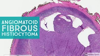 Angiomatoid Fibrous Histiocytoma 101 Note its NOT aneurysmal dermatofibroma [upl. by Heiney]