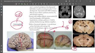 5 Lissencephaly [upl. by Hagerman665]