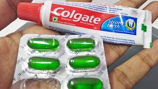 Natural Beauty Hacks For Remove Pimples Overnight  Vitamin E Capsule Colgate Toothpaste Beauty tips [upl. by Ailedua]