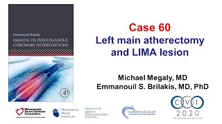 Case 60 PCI Manual  Left main and LIMA PCI in a prior CABG patient [upl. by Zacek]