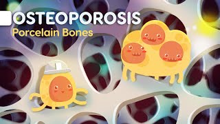 Osteoporosis symptoms and causes  Everything you need to know explained easily [upl. by Jaco346]