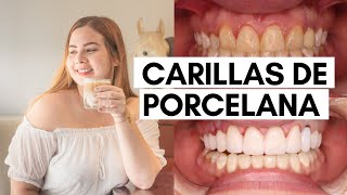 Los que NO te dicen sobre las carillas de porcelana Dolor Costo Vale la pena carillasdentales [upl. by Yenitsed196]