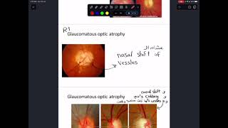 practical ophthalmology 2 [upl. by Wickner]