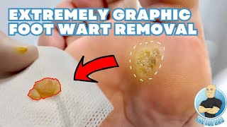 EXTREMELY GRAPHIC FOOT WART REMOVAL 5 YEARS OF UNSUCCESSFUL TREATMENT [upl. by Brinson]