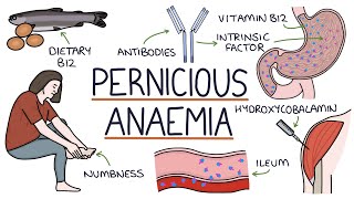 Understanding Pernicious Anaemia B12 Deficiency [upl. by Eiramana949]