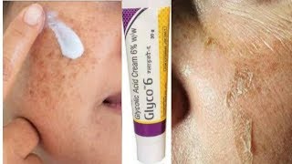 Glyco 6 Cream  glycolic acid  Remove pigmentation  Acne Scars  pimple marks [upl. by Anidene]