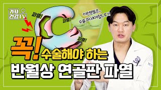 반월상 연골 파열 수술 꼭 해야 할까 자연치유가 안되는 반월상연골판파열 유형 [upl. by Lesna875]