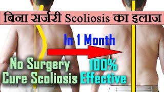 Scoliosis100 Effective Scoliosis Treatment Exercises At Homeस्कोलियोसिस का बिना सर्जरी इलाज [upl. by Nnawaj]