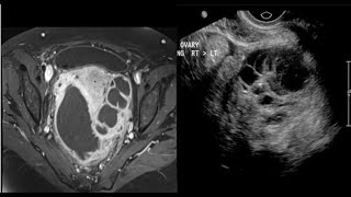 15casepelvicGUgenitourinaryfemaleimagingRenalbladderUSCTMRIRadiologyradiopediafrcrtip [upl. by Lenuahs289]