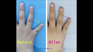 brachydactyly 短指症手術 短指症 단지증 단지증수술 단지증수술후기 braquidactilia عضدي الأصابع брахидактилия [upl. by Aiouqes]