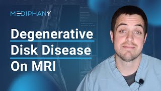 Degenerative Changes of the Lumbar Spine on MRI [upl. by Wenoa]