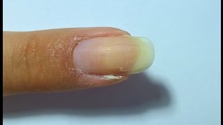 How to series  Get rid of a hangnail [upl. by Arayk247]